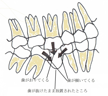 噛み合わせが悪いまま放置すると