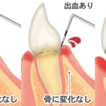 皆さんのお口は大丈夫？～歯周ポケットについて～