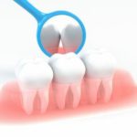 虫歯と歯周病は感染症