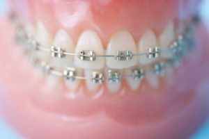 目立たない矯正とはについて