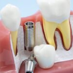 インプラント費用の全貌！～長期的価値を見極める投資判断～